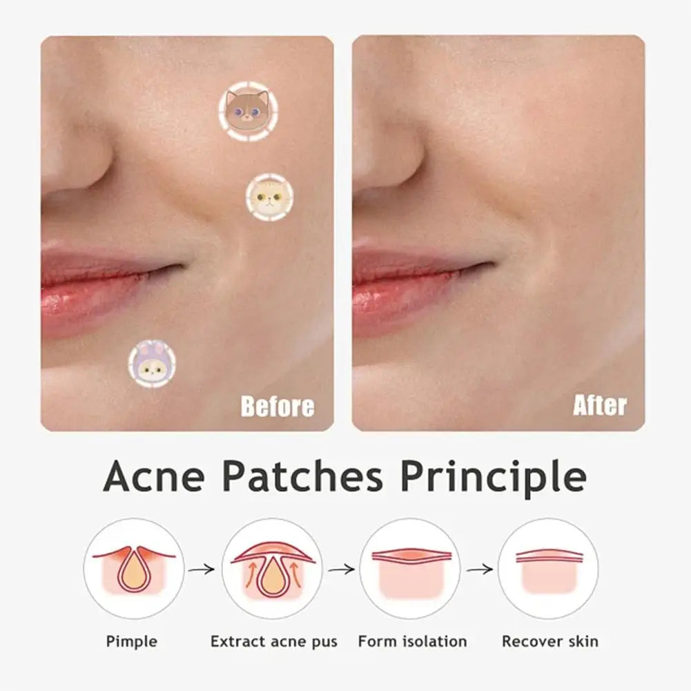 600 Pcs Ance Patches Cute Pimple Patches For Face Salicylic Acid & Tea Tree Cute Cat Pimple Stickers