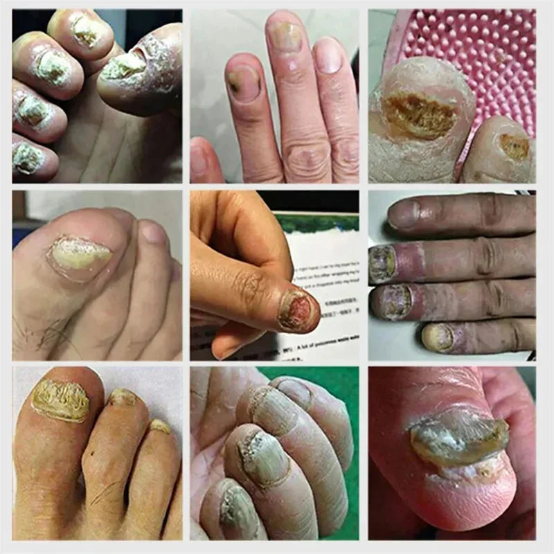 Fungal Nail Treatment Serum - Fast-Acting Repair Gel for Nail Fungus & Infections