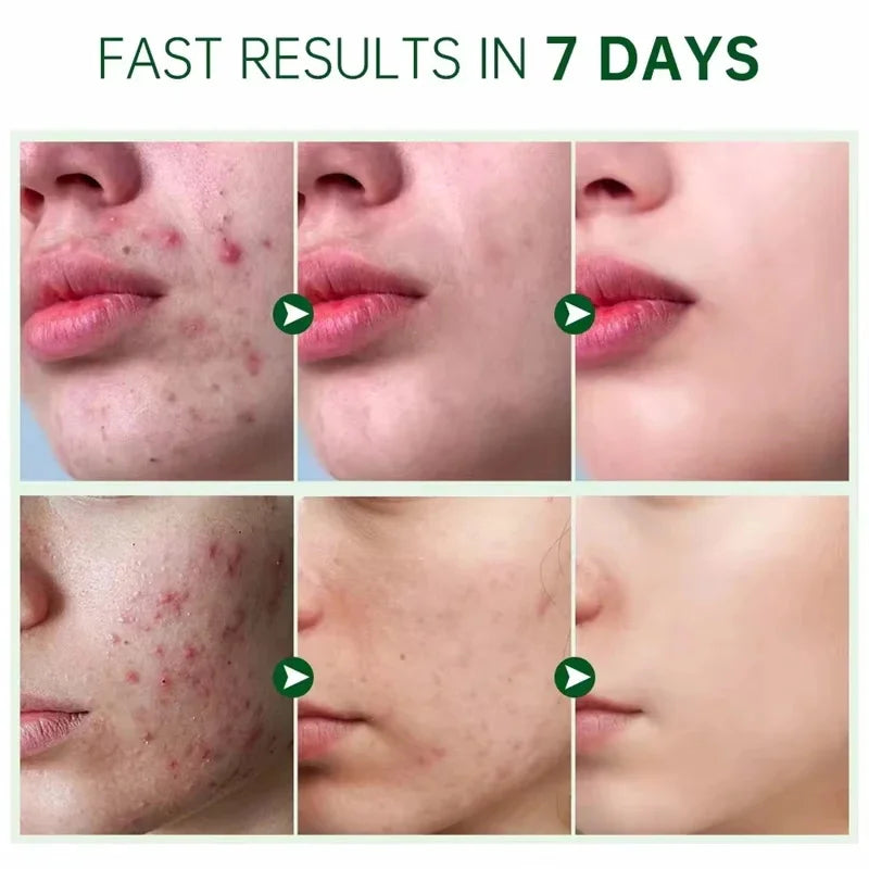 Salicylic Acid Acne Treatment Cream - Deep Pore Cleansing & Oil Control