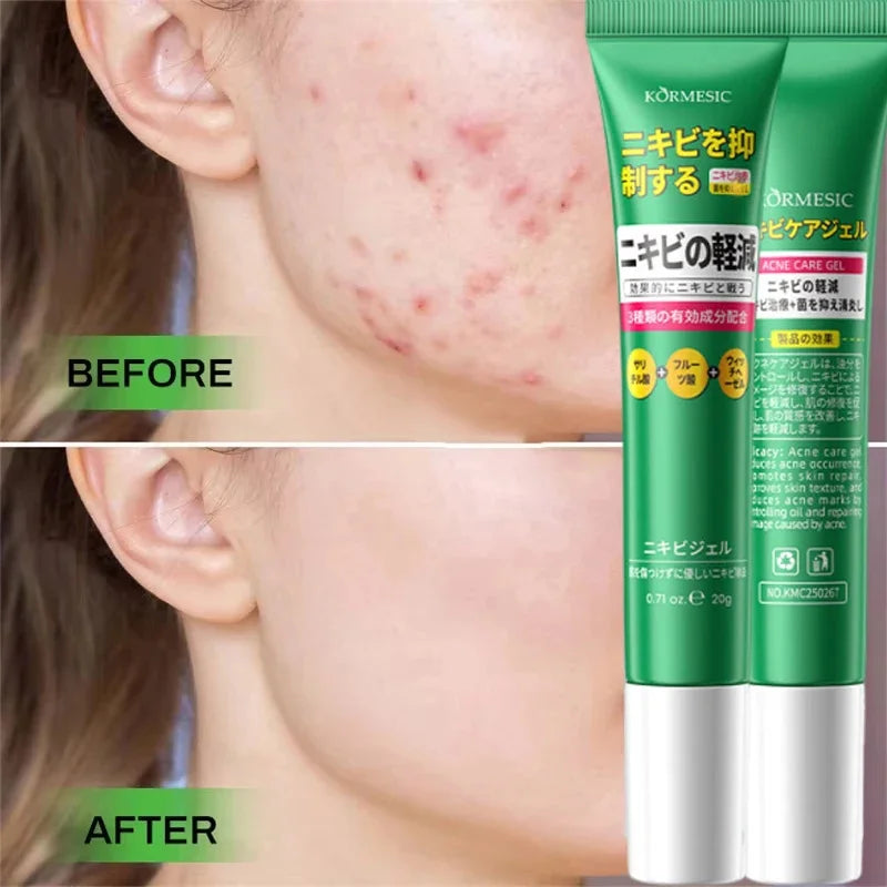 Salicylic Acid Acne Treatment Cream - Deep Pore Cleansing & Oil Control