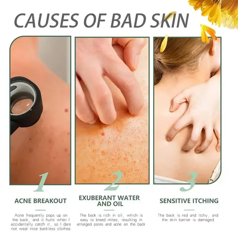 Salicylic Acid Acne Treatment Cream - Deep Pore Cleansing & Oil Control
