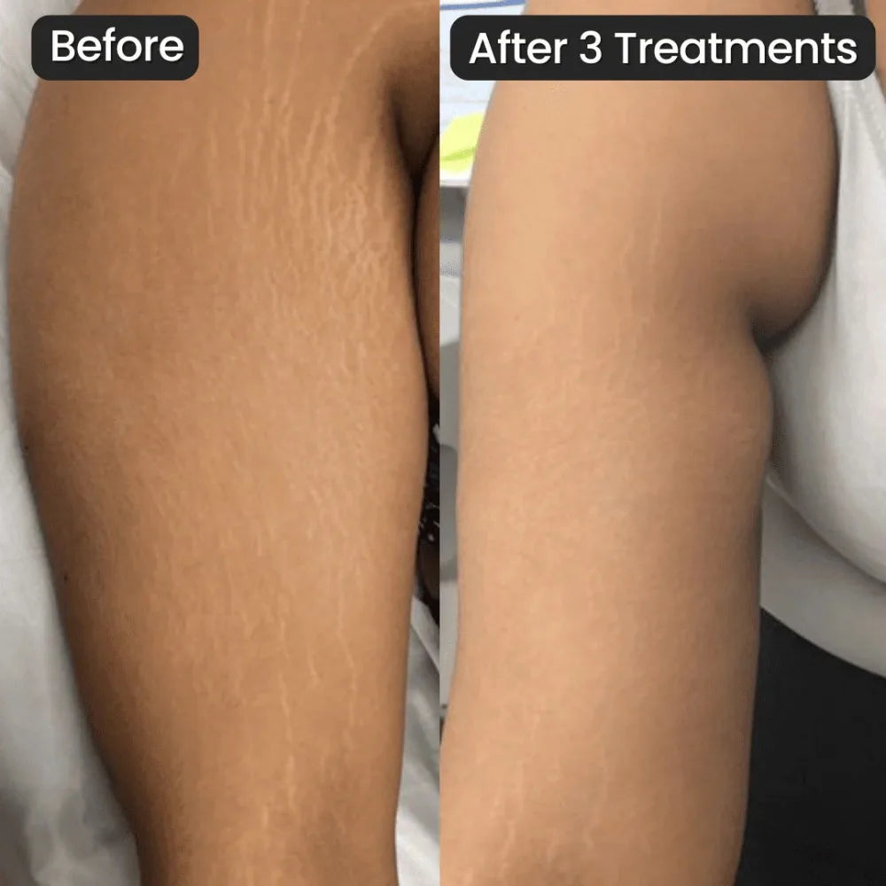 Hyaluronic Acid Essence Roll-On Set – Moisturizing & Firming