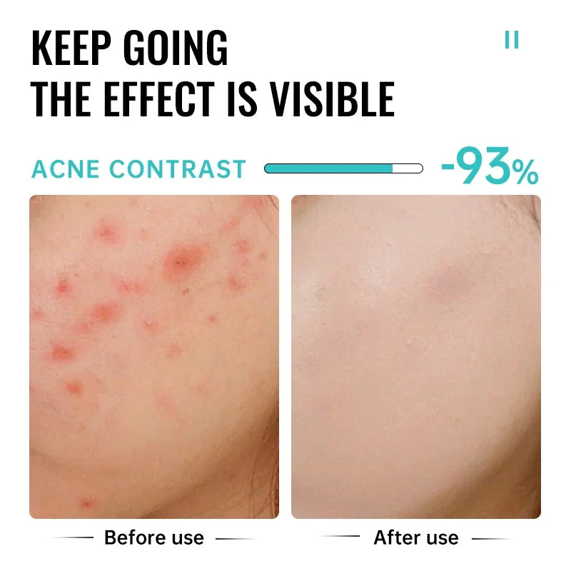 Salicylic Acid Acne Treatment Cream - Pore Shrinking, Oil Control & Brightening