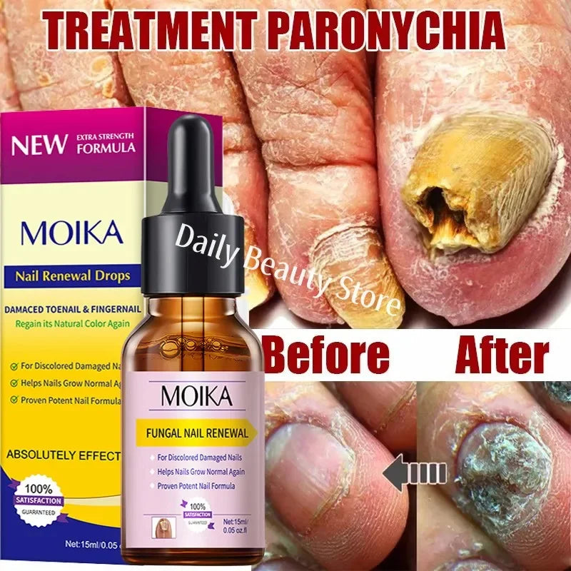Fungal Nail Treatment Serum - Fast-Acting Repair Gel for Nail Fungus & Infections