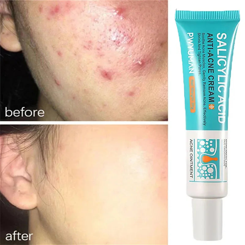 Salicylic Acid Acne Treatment Cream - Deep Pore Cleansing & Oil Control
