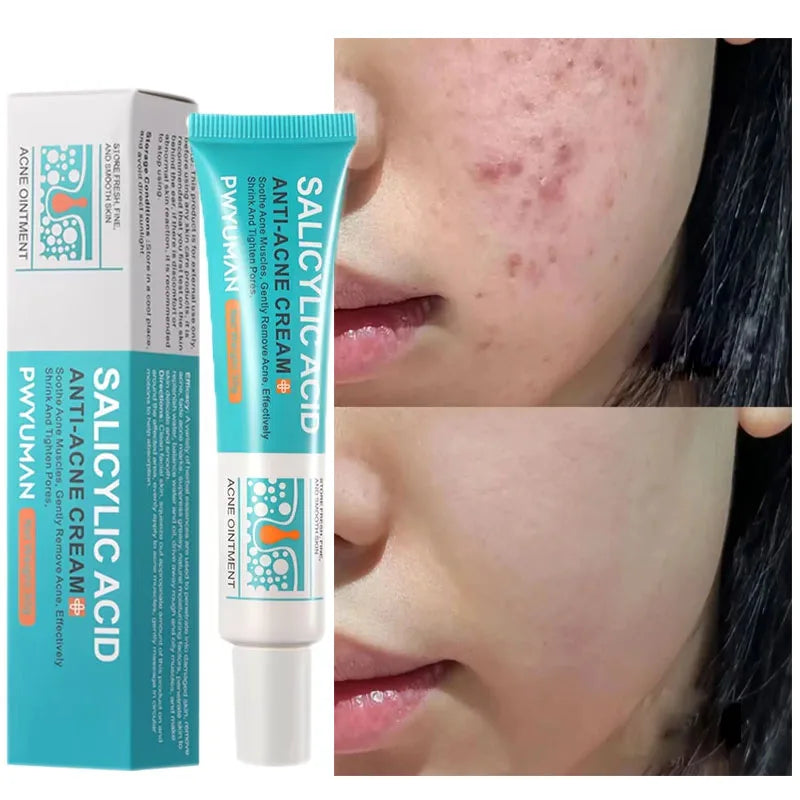 Salicylic Acid Acne Treatment Cream - Deep Pore Cleansing & Oil Control