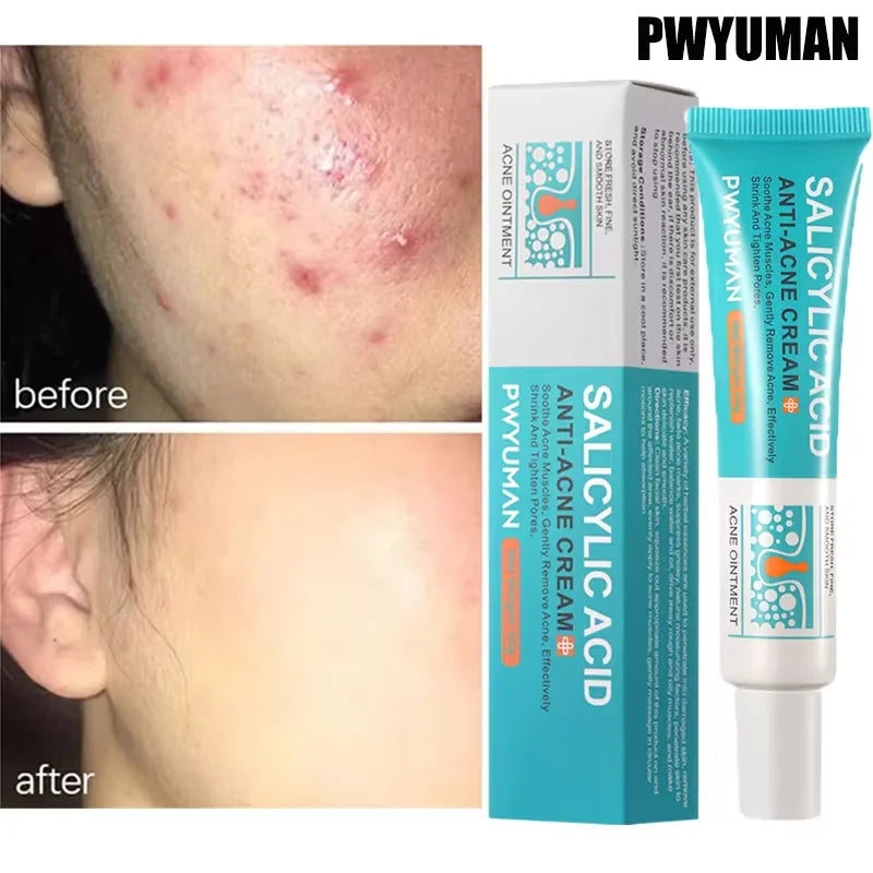 Salicylic Acid Acne Treatment Cream - Deep Pore Cleansing & Oil Control