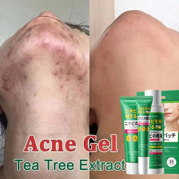 Salicylic Acid Acne Treatment Cream - Deep Pore Cleansing & Oil Control