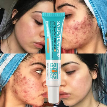 Salicylic Acid Acne Treatment Cream - Deep Pore Cleansing & Oil Control