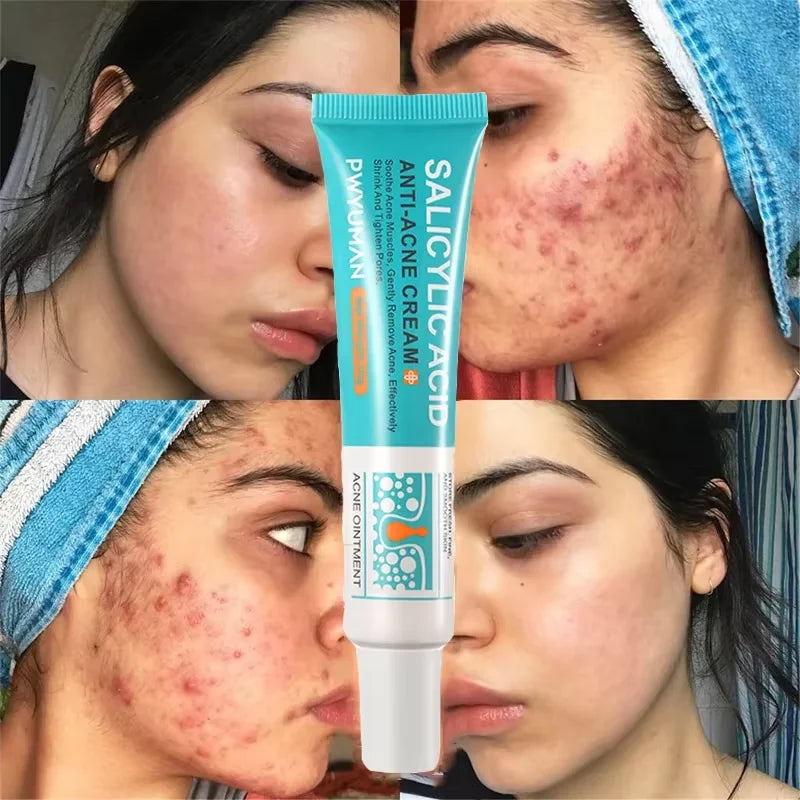 Salicylic Acid Acne Treatment Cream - Deep Pore Cleansing & Oil Control