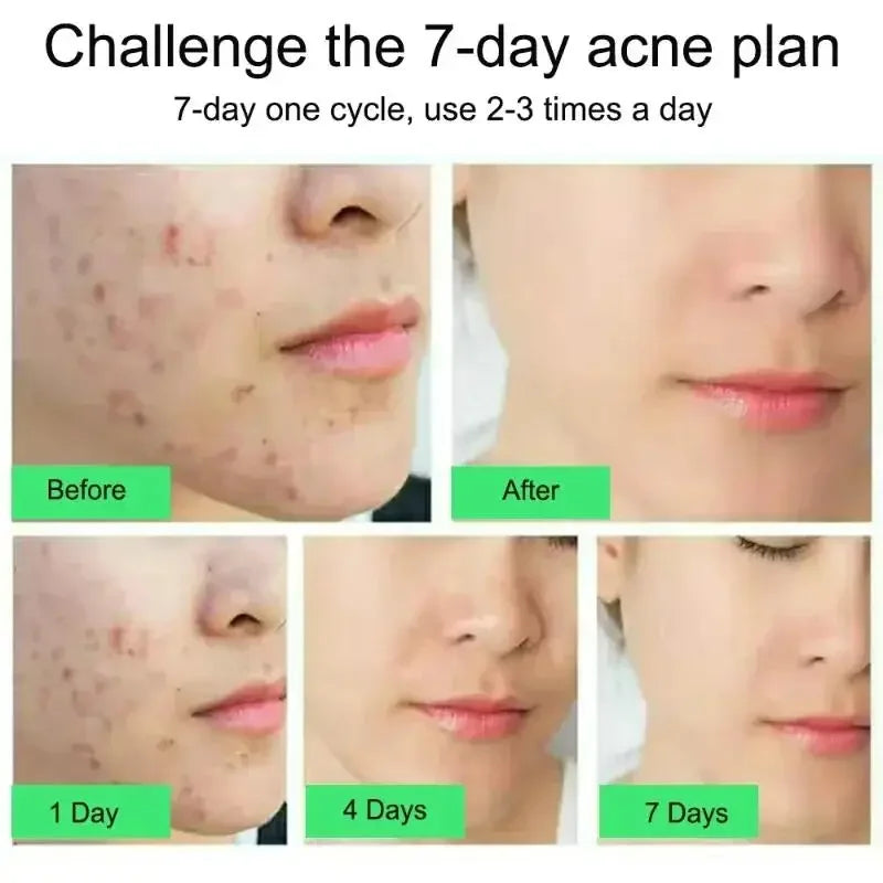 Salicylic Acid Acne Treatment Cream - Pore Shrinking, Oil Control & Brightening