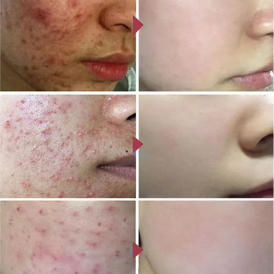 Salicylic Acid Acne Treatment Cream - Deep Pore Cleansing & Oil Control