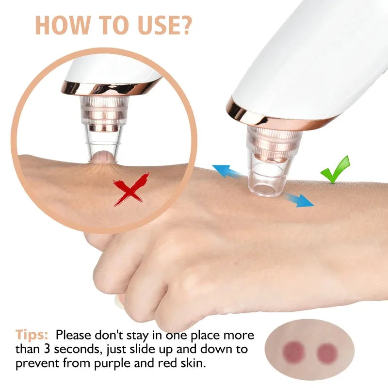 Electric Blackhead Remover Vacuum with 3 Suction Levels & 5 Heads