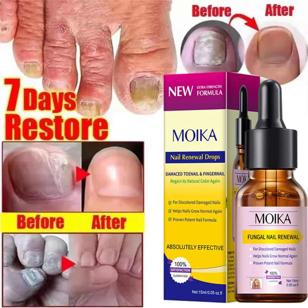 Fungal Nail Treatment Serum - Fast-Acting Repair Gel for Nail Fungus & Infections