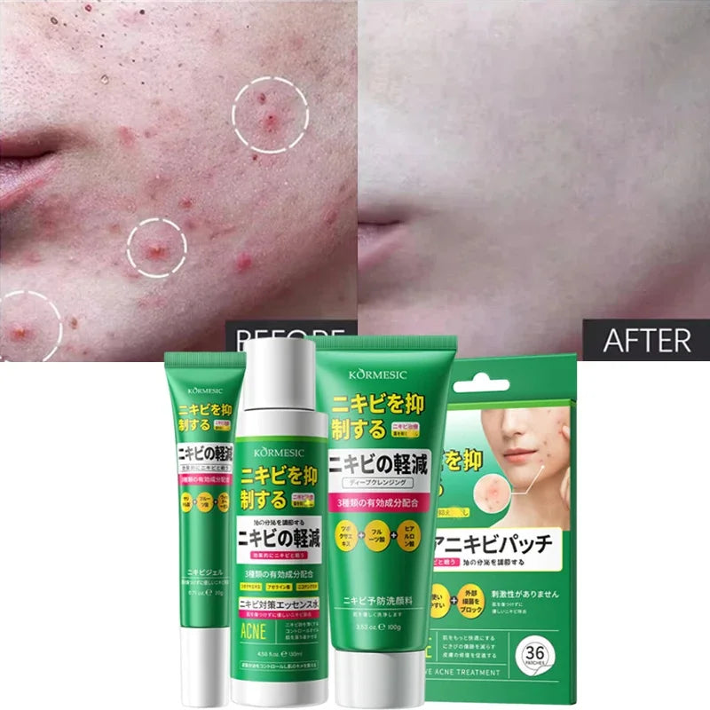 Salicylic Acid Acne Treatment Cream - Deep Pore Cleansing & Oil Control