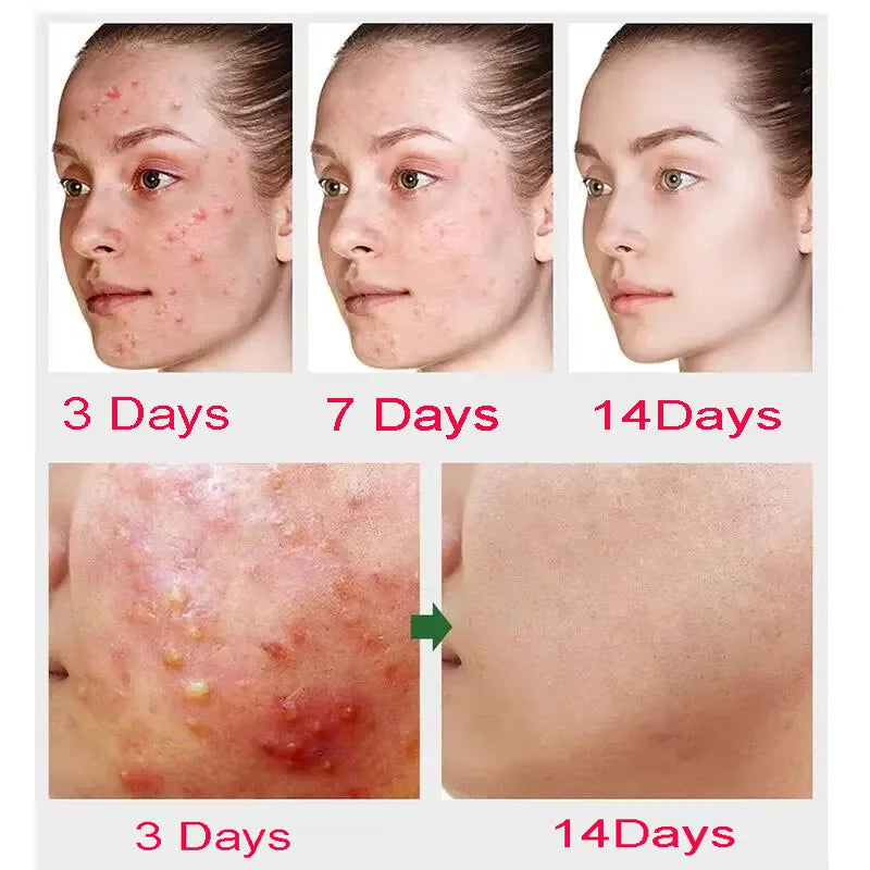 Salicylic Acid Acne Treatment Cream - Deep Pore Cleansing & Oil Control