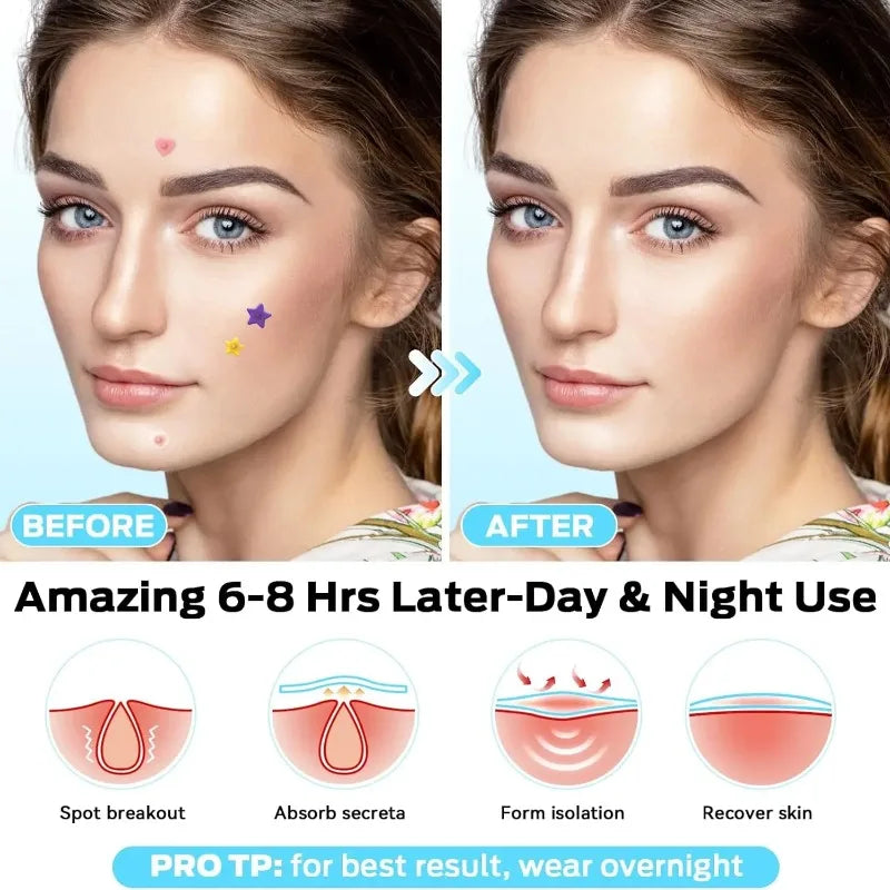 200-Piece Colorful Acne Patches - Waterproof Hydrocolloid Pimple Stickers