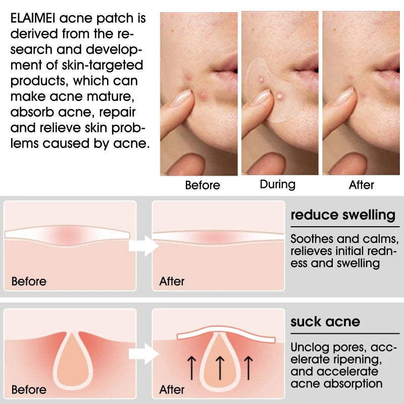 20 Patches Acne Patch Pimple Patches Blemish Protective Cover Absorbing Spot Hydrocolloid Dressing Zit Drop Shipping